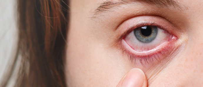 ¿Cómo evitar que se te resequen los ojos al usar lentes de contacto?
